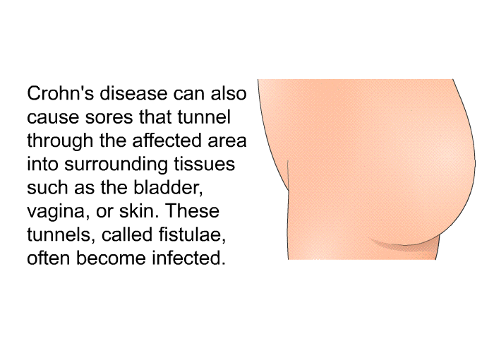 Crohn's disease can also cause sores that tunnel through the affected area into surrounding tissues such as the bladder, vagina, or skin. These tunnels, called fistulae, often become infected.