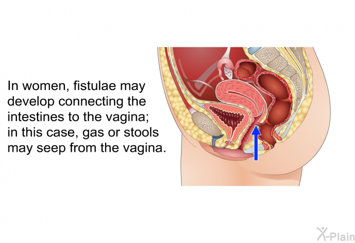 In women, fistulae may develop connecting the intestines to the vagina; in this case, gas or stools may seep from the vagina.