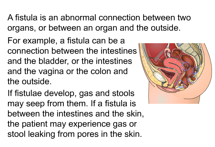 A fistula is an abnormal connection between two organs, or between an organ and the outside. For example, a fistula can be a connection between the intestines and the bladder, or the intestines and the vagina or the colon and the outside. If fistulae develop, gas and stools may seep from them. If a fistula is between the intestines and the skin, the patient may experience gas or stool leaking from pores in the skin.