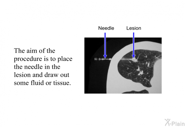 The aim of the procedure is to place the needle in the lesion and draw out some fluid or tissue.