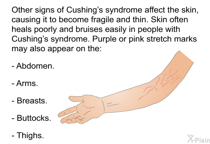 Other signs of Cushing's syndrome affect the skin, causing it to become fragile and thin. Skin often heals poorly and bruises easily in people with Cushing's syndrome. Purple or pink stretch marks may also appear on the:  Abdomen. Arms. Breasts. Buttocks. Thighs.