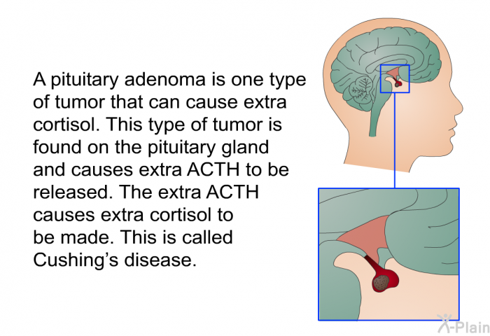 A pituitary adenoma is one type of tumor that can cause extra cortisol. This type of tumor is found on the pituitary gland and causes extra ACTH to be released. The extra ACTH causes extra cortisol to be made. This is called Cushing's disease.