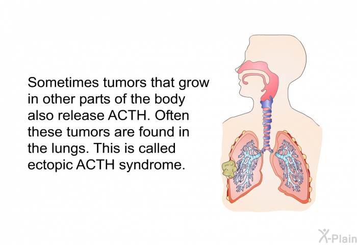 Sometimes tumors that grow in other parts of the body also release ACTH. Often these tumors are found in the lungs. This is called ectopic ACTH syndrome.