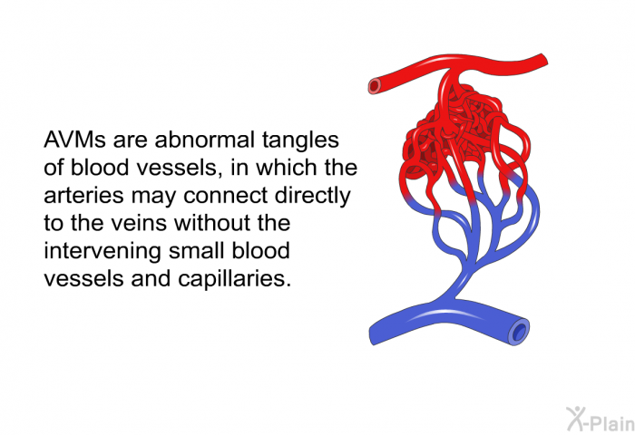 AVMs are abnormal tangles of blood vessels, in which the arteries may connect directly to the veins without the intervening smaller blood vessels and capillaries.