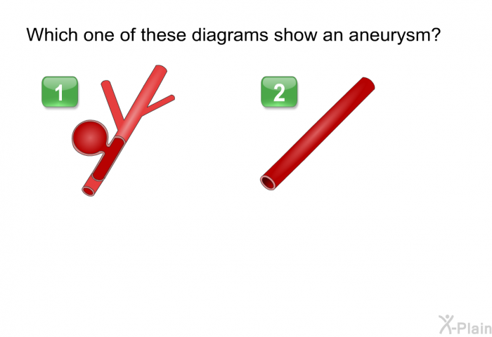 Which of the following AVMs has an aneurysm? (A points to an AVM that has a ballooning blood vessel. B points to an AVM without a ballooning structure.)