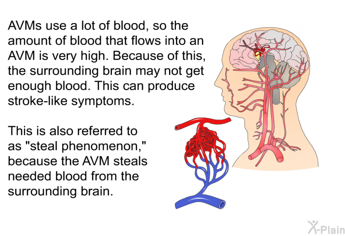 AVMs use a lot of blood, so the amount of blood that flows into an AVM is very high. Because of this, the surrounding brain may not get enough blood. This can produce stroke-like symptoms. This is also referred to as “steal phenomenon,” because the AVM steals needed blood from the surrounding brain.
