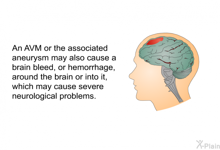 An AVM or the associated aneurysm may also cause a brain bleed, or hemorrhage, around the brain or into it, which may cause severe neurological problems.