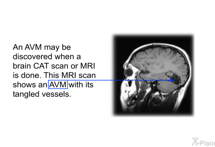 An AVM may be discovered when a brain CAT scan or MRI is done. This MRI scan shows an AVM with its tangled vessels.