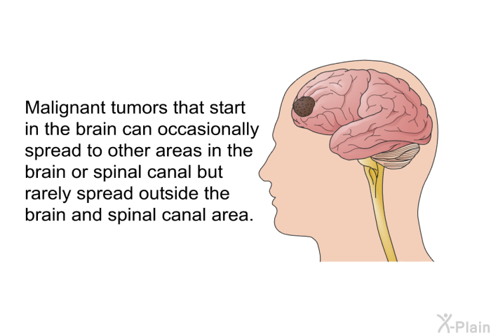 Malignant tumors that start in the brain can occasionally spread to other areas in the brain or spinal canal but rarely spread outside the brain and spinal canal area.