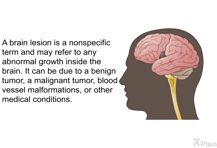 A brain lesion is a nonspecific term and may refer to any abnormal growth inside the brain. It can be due to a benign tumor, a malignant tumor, blood vessel malformations, or other medical conditions.