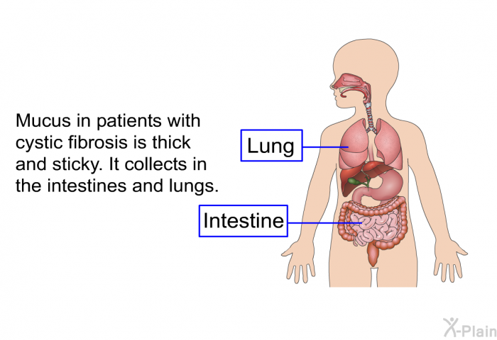 Mucus in patients with cystic fibrosis is thick and sticky. It collects in the intestines and lungs.