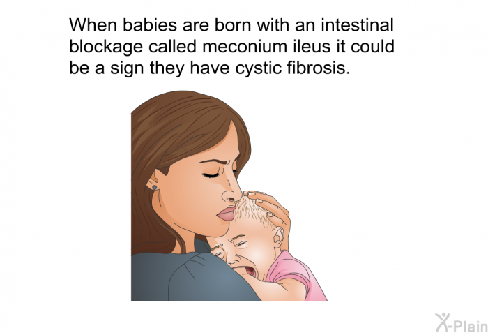 When babies are born with an intestinal blockage called meconium ileus it could be a sign they have cystic fibrosis.