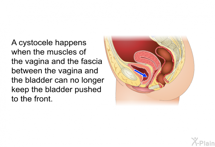 A cystocele happens when the muscles of the vagina and the fascia between the vagina and the bladder can no longer keep the bladder pushed to the front.