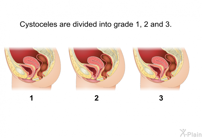 Cystoceles are divided into grade 1, 2 and 3.