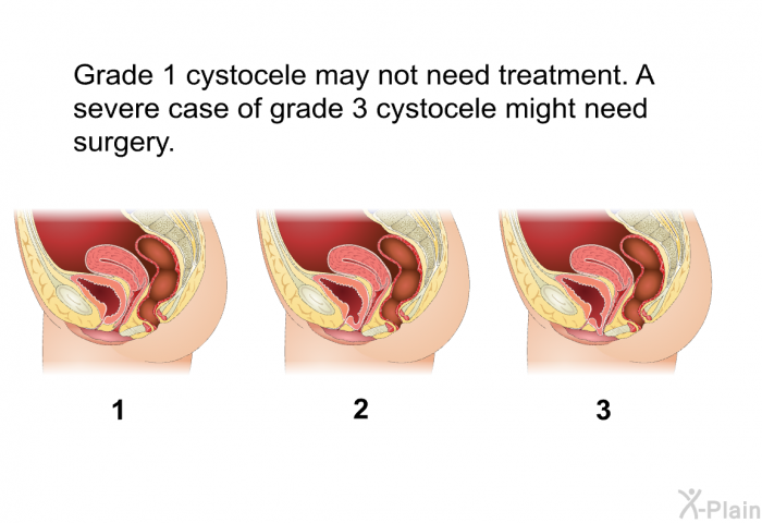 Grade 1 cystocele may not need treatment. A severe case of grade 3 cystocele might need surgery.