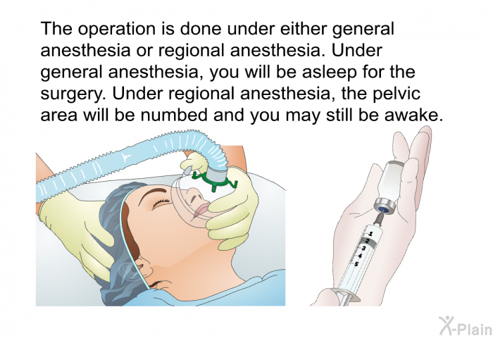 The operation is done under either general anesthesia or regional anesthesia. Under general anesthesia, you will be asleep for the surgery. Under regional anesthesia, the pelvic area will be numbed and you may still be awake.