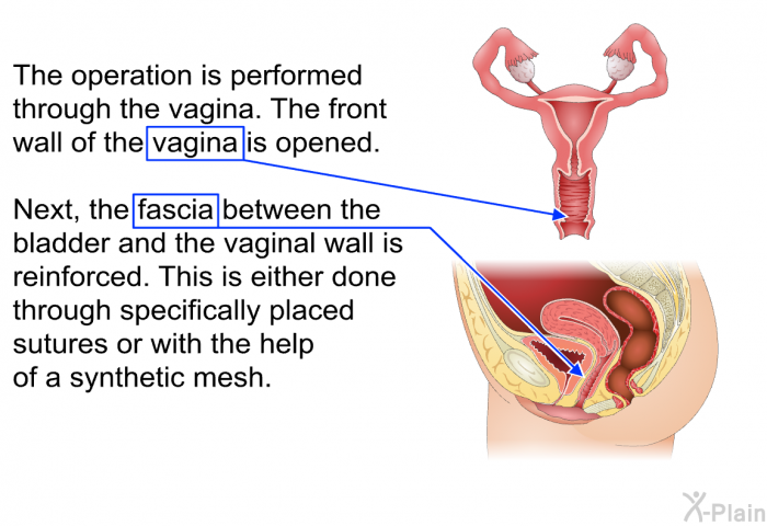 The operation is performed through the vagina. The front wall of the vagina is opened. Next, the fascia between the bladder and the vaginal wall is reinforced. This is either done through specially placed sutures or with the help of a synthetic mesh.