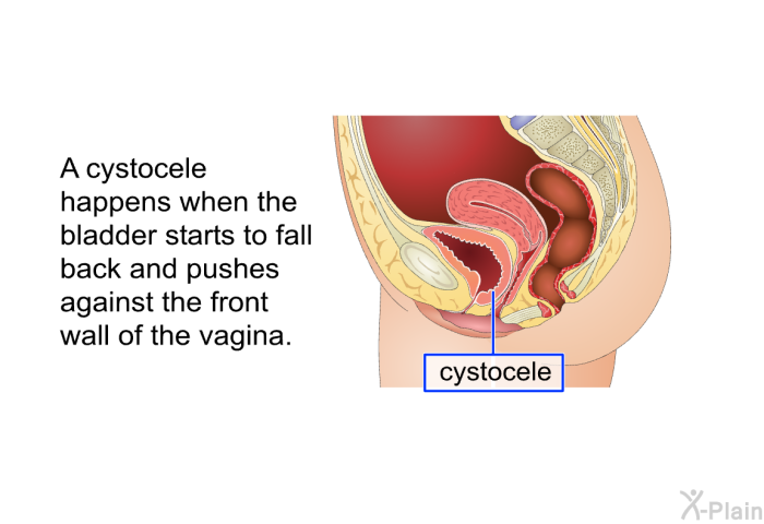 A cystocele happens when the bladder starts to fall back and pushes against the front wall of the vagina.