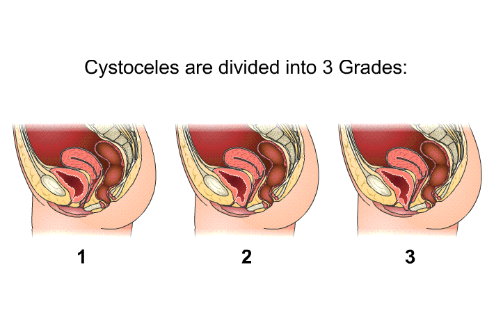 Cystoceles are divided into 3 grades: