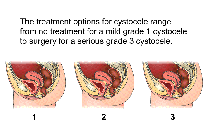 The treatment options for cystocele range from no treatment for a mild grade 1 cystocele to surgery for a serious grade 3 cystocele.