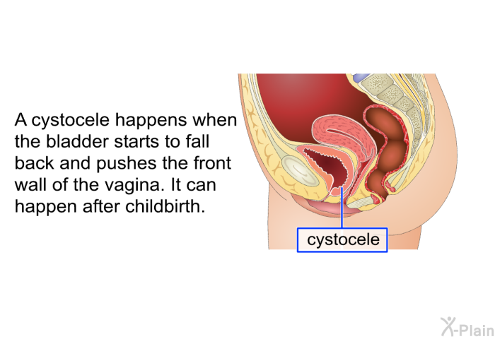 A cystocele happens when the bladder starts to fall back and pushes the front wall of the vagina. It can happen after childbirth.