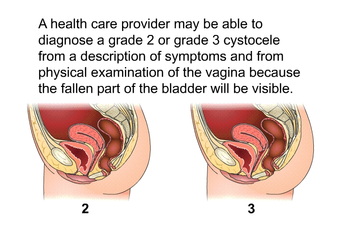 A health care provider may be able to diagnose a grade 2 or grade 3 cystocele from a description of symptoms and from physical examination of the vagina because the fallen part of the bladder will be visible.