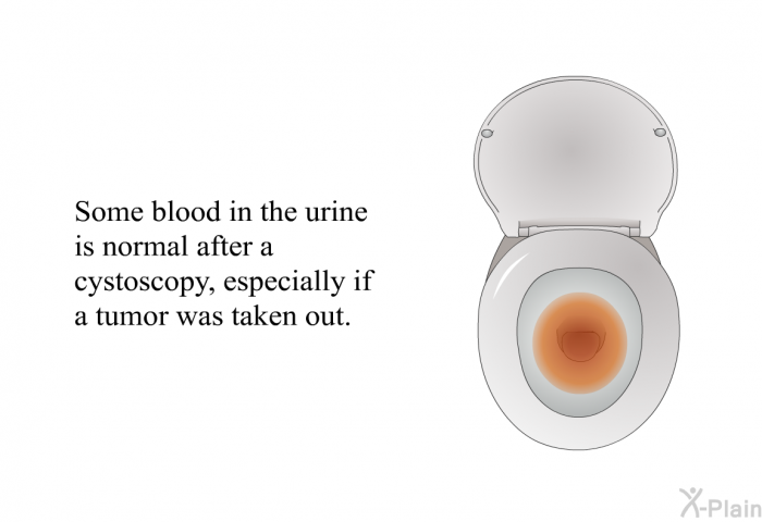 Some blood in the urine is normal after a cystoscopy, especially if a tumor was taken out.