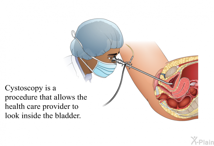 Cystoscopy is a procedure that allows the health care provider to look inside the bladder.