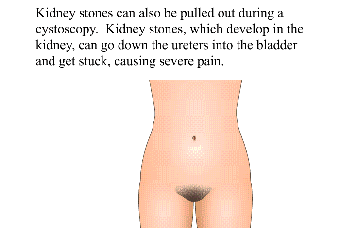 Kidney stones can also be pulled out during a cystoscopy. Kidney stones, which develop in the kidney, can go down the ureters into the bladder and get stuck, causing severe pain.