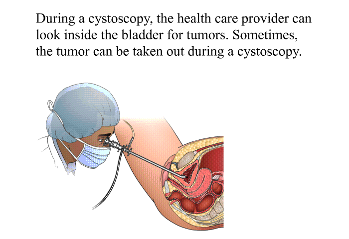 During a cystoscopy, the health care provider can look inside the bladder for tumors. Sometimes, the tumor can be taken out during a cystoscopy.
