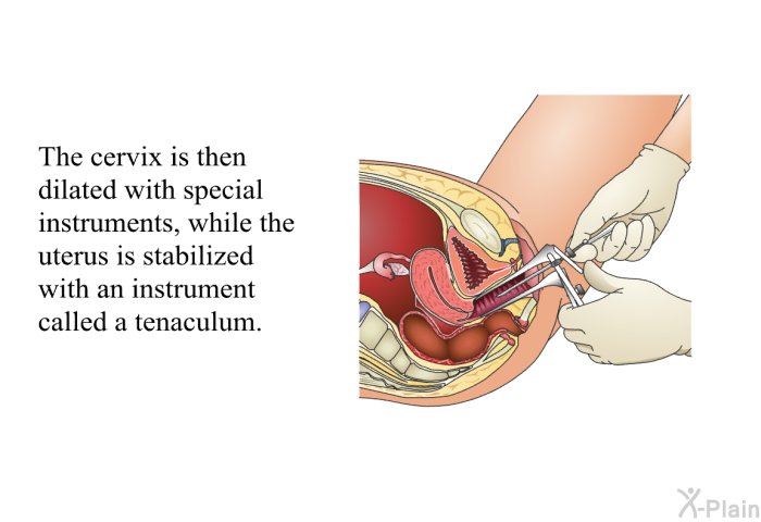 The cervix is then dilated with special instruments, while the uterus is stabilized with an instrument called a tenaculum.