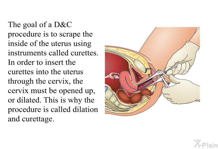 The goal of a D&C procedure is to scrape the inside of the uterus using instruments called curettes. In order to insert the curettes into the uterus through the cervix, the cervix must be opened up, or dilated. This is why the procedure is called dilation and curettage.