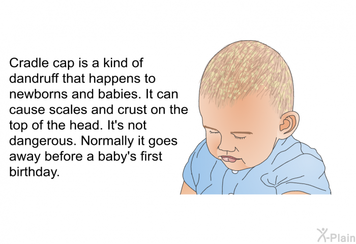Cradle cap is a kind of dandruff that happens to newborns and babies. It can cause scales and crust on the top of the head. It's not dangerous. Normally it goes away before a baby's first birthday.