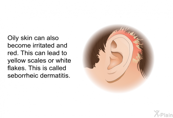 Oily skin can also become irritated and red. This can lead to yellow scales or white flakes. This is called seborrheic dermatitis.