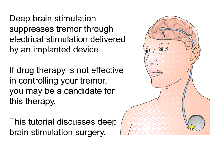 Deep brain stimulation suppresses tremor through electrical stimulation delivered by an implanted device. If drug therapy is not effective in controlling your tremor, you may be a candidate for this therapy. This health information discusses deep brain stimulation surgery.