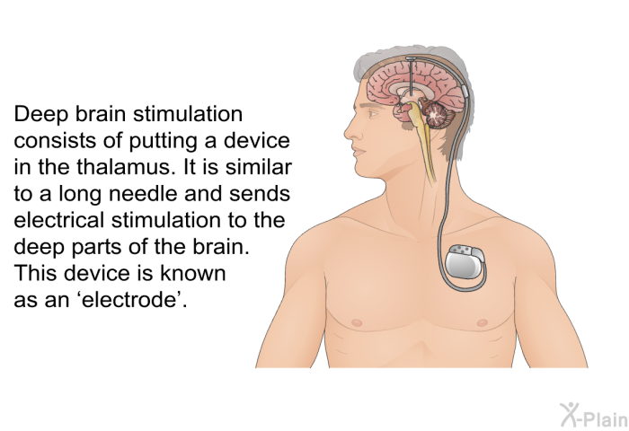 Deep brain stimulation consists of putting a device in the thalamus. It is similar to a long needle and sends electrical stimulation to the deep parts of the brain. This device is known as an  electrode'.