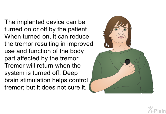 The implanted device can be turned on or off by the patient. When turned on, it can reduce the tremor resulting in improved use and function of the body part affected by the tremor. Tremor will return when the system is turned off. Deep brain stimulation helps control tremor; but it does not cure it.