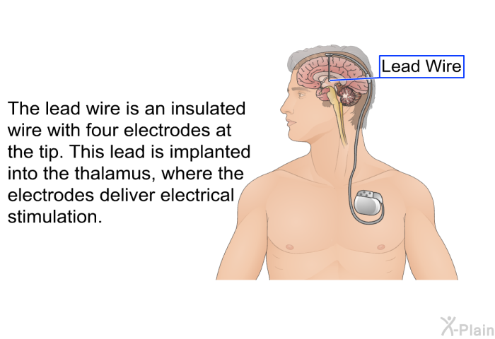 The lead wire is an insulated wire with four electrodes at the tip. This lead is implanted into the thalamus, where the electrodes deliver electrical stimulation.