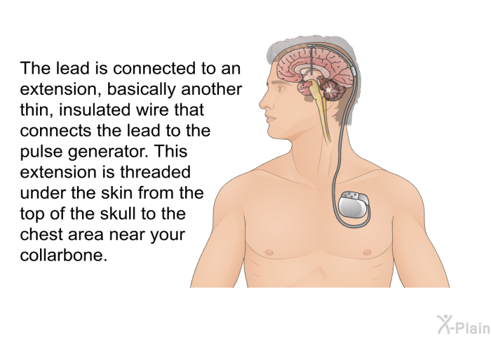 The lead is connected to an extension, basically another thin, insulated wire that connects the lead to the pulse generator. This extension is threaded under the skin from the top of the skull to the chest area near your collarbone.