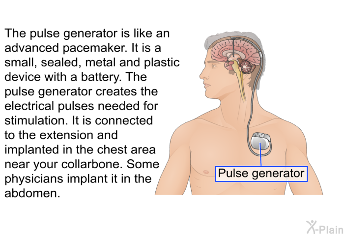 The pulse generator is like an advanced pacemaker. It is a small, sealed, metal and plastic device with a battery. The pulse generator creates the electrical pulses needed for stimulation. It is connected to the extension and implanted in the chest area near your collarbone. Some physicians implant it in the abdomen.