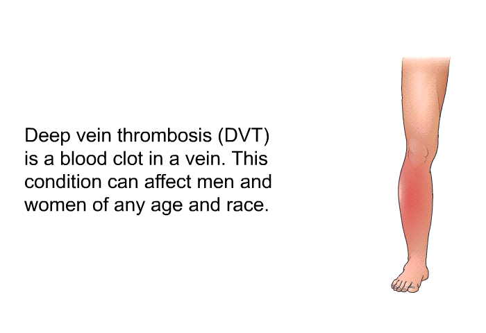 Deep vein thrombosis (DVT) is a blood clot in a vein. This condition can affect men and women of any age and race.
