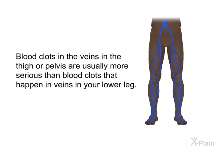 Blood clots in the veins in the thigh or pelvis are usually more serious than blood clots that happen in veins in your lower leg.