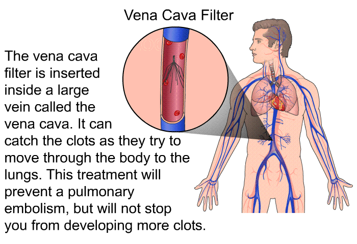 The vena cava filter is inserted inside a large vein called the vena cava. It can catch the clots as they try to move through the body to the lungs. This treatment will prevent a pulmonary embolism, but will not stop you from developing more clots.