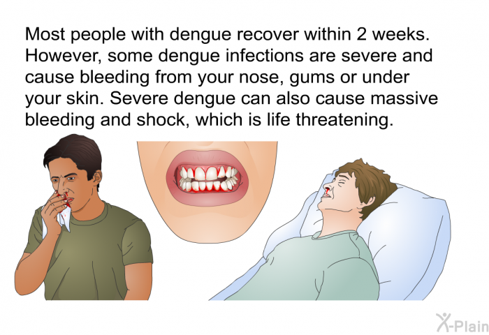 Most people with dengue recover within 2 weeks. However, some dengue infections are severe and cause bleeding from your nose, gums or under your skin. Severe dengue can also cause massive bleeding and shock, which is life threatening.
