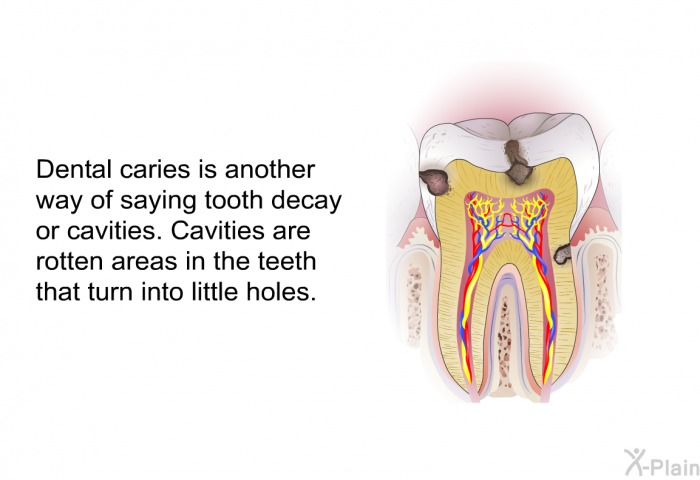Dental caries is another way of saying tooth decay or cavities. Cavities are rotten areas in the teeth that turn into little holes.