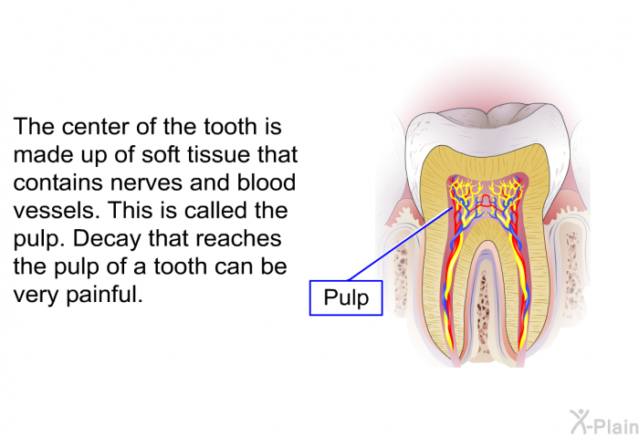 The center of the tooth is made up of soft tissue that contains nerves and blood vessels. This is called the pulp. Decay that reaches the pulp of a tooth can be very painful.