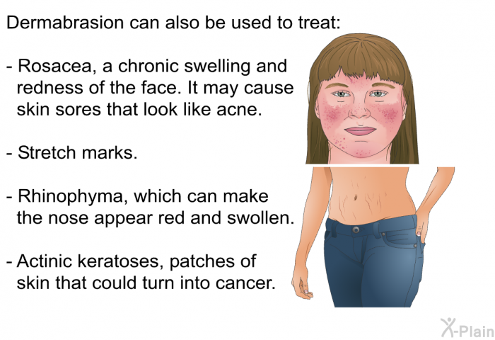 Dermabrasion can also be used to treat:  Rosacea, a chronic swelling and redness of the face. It may cause skin sores that look like acne. Stretch marks. Rhinophyma, which can make the nose appear red and swollen. Actinic keratoses, patches of skin that could turn into cancer.