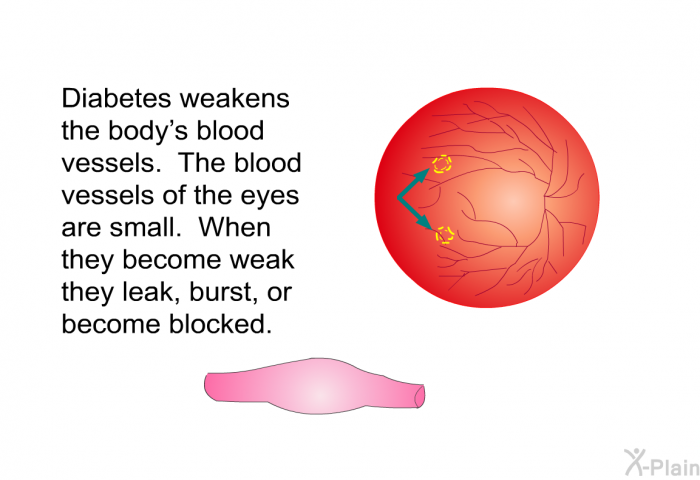 Diabetes weakens the body's blood vessels. The blood vessels of the eyes are small. When they become weak they leak, burst, or become blocked.