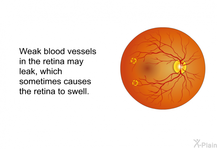 Weak blood vessels in the retina may leak, which sometimes causes the retina to swell.