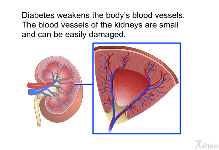 Diabetes weakens the body's blood vessels. The blood vessels of the kidneys are small and can be easily damaged.